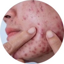 Acne
