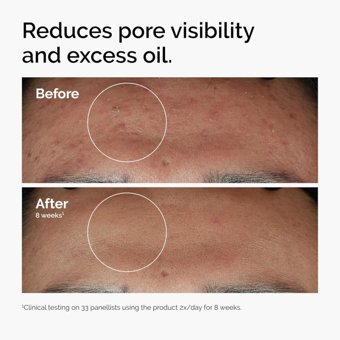 The Ordinary Niacinamide 10% + Zinc 1% | 100% Canada Imported image 2