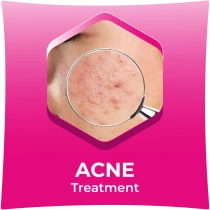 Acne Treatment