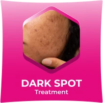 Dark Spot Treatment
