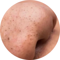 Black Heads