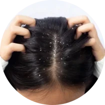 Dandruff Solution