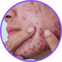 Acne Prone